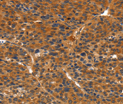 Immunohistochemistry of paraffin-embedded Human liver cancer tissue using IKZF3 Polyclonal Antibody at dilution 1:60