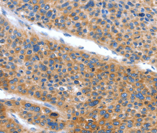 Immunohistochemistry of paraffin-embedded Human liver cancer tissue using ARL11 Polyclonal Antibody at dilution 1:50