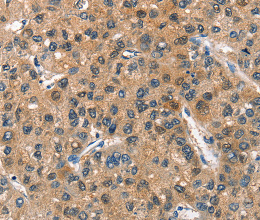 Immunohistochemistry of paraffin-embedded Human liver cancer tissue using ASB2 Polyclonal Antibody at dilution 1:40