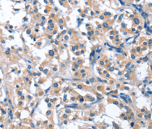 Immunohistochemistry of paraffin-embedded Human thyroid cancer tissue using ASB2 Polyclonal Antibody at dilution 1:40