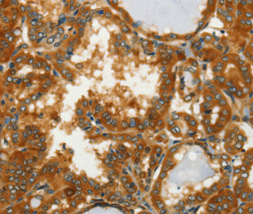 Immunohistochemistry of paraffin-embedded Human thyroid cancer using GOT1 Polyclonal Antibody at dilution of 1:50