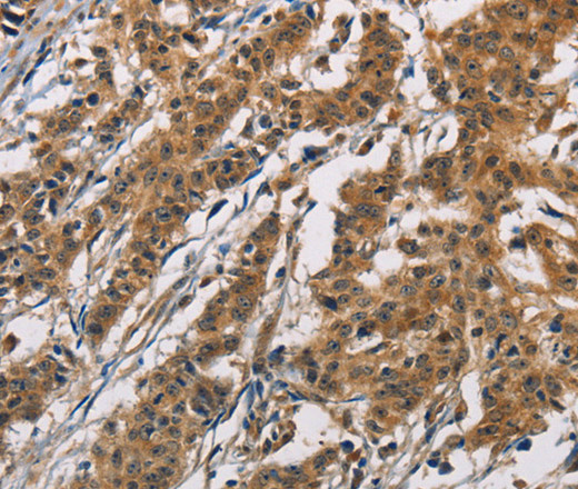 Immunohistochemistry of paraffin-embedded Human gasrtic cancer tissue using ATP2C1 Polyclonal Antibody at dilution 1:60