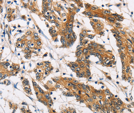 Immunohistochemistry of paraffin-embedded Human colon cancer tissue using ATP2C1 Polyclonal Antibody at dilution 1:60