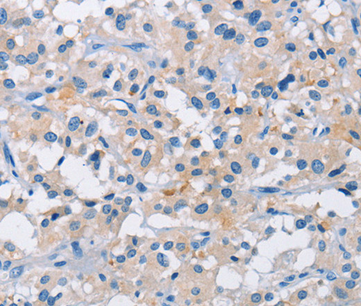 Immunohistochemistry of paraffin-embedded Human thyroid cancer tissue using ATP6AP2 Polyclonal Antibody at dilution 1:50