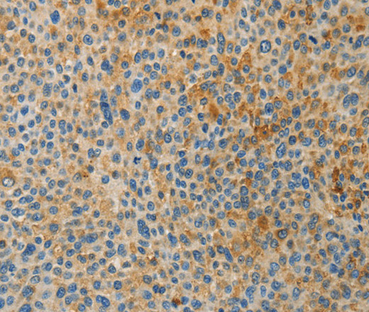 Immunohistochemistry of paraffin-embedded Human liver cancer using BAAT Polyclonal Antibody at dilution of 1:30