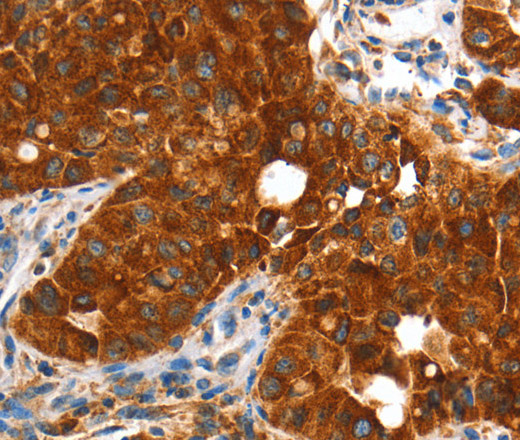 Immunohistochemistry of paraffin-embedded Human lung cancer using VWA5A Polyclonal Antibody at dilution of 1:60