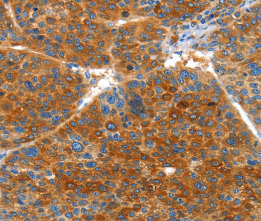 Immunohistochemistry of paraffin-embedded Human liver cancer using VWA5A Polyclonal Antibody at dilution of 1:60