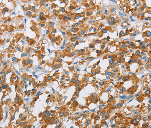 Immunohistochemistry of paraffin-embedded Human thyroid cancer tissue using BDH1 Polyclonal Antibody at dilution 1:60