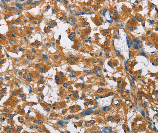 Immunohistochemistry of paraffin-embedded Human thyroid cancer using COPB1 Polyclonal Antibody at dilution of 1:50