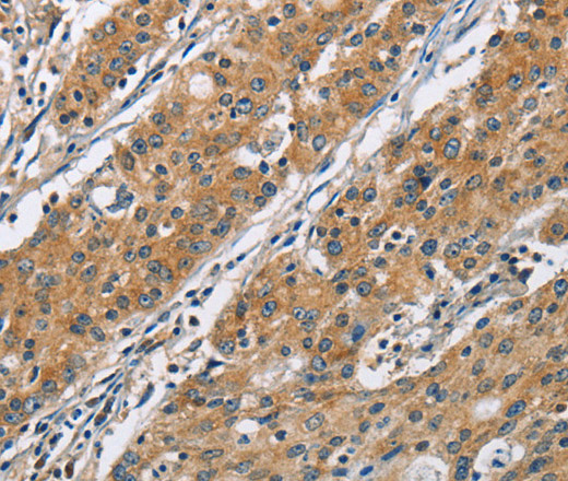 Immunohistochemistry of paraffin-embedded Human gastric cancer using COPB1 Polyclonal Antibody at dilution of 1:50