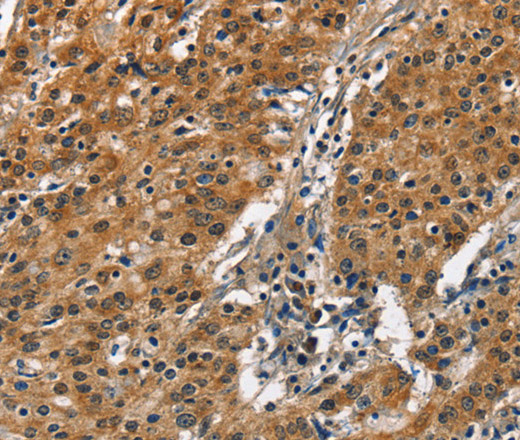 Immunohistochemistry of paraffin-embedded Human gastric cancer tissue using SLAMF8 Polyclonal Antibody at dilution 1:50