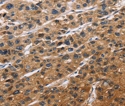 Immunohistochemistry of paraffin-embedded Human liver cancer tissue using EIF4EBP2 Polyclonal Antibody at dilution 1:40