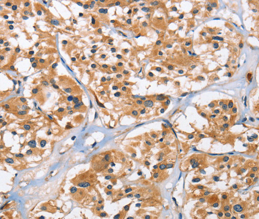 Immunohistochemistry of paraffin-embedded Human thyroid cancer tissue using EIF4EBP2 Polyclonal Antibody at dilution 1:40