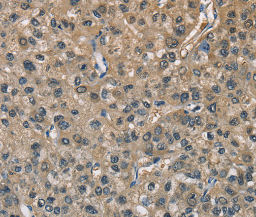 Immunohistochemistry of paraffin-embedded Human liver cancer using ENO1 Polyclonal Antibody at dilution of 1:40