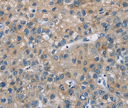 Immunohistochemistry of paraffin-embedded Human liver cancer using CAB39L Polyclonal Antibody at dilution of 1:30