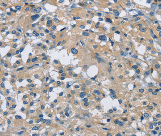 Immunohistochemistry of paraffin-embedded Human thyroid cancer using CAB39L Polyclonal Antibody at dilution of 1:30