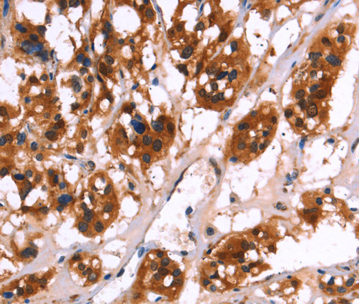 Immunohistochemistry of paraffin-embedded Human thyroid cancer using CALB1 Polyclonal Antibody at dilution of 1:50