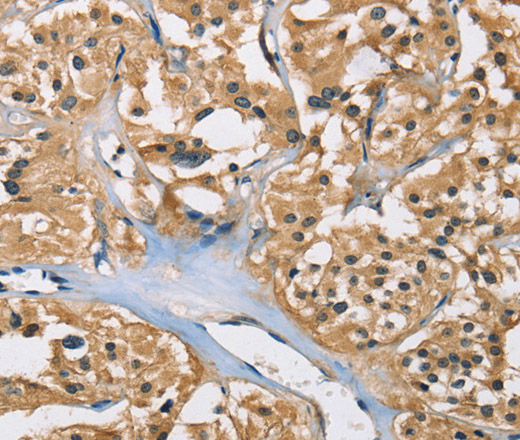 Immunohistochemistry of paraffin-embedded Human thyroid cancer using PPP3CA Polyclonal Antibody at dilution of 1:40