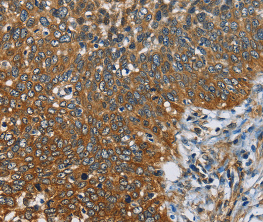 Immunohistochemistry of paraffin-embedded Human cervical cancer using CAST Polyclonal Antibody at dilution of 1:60