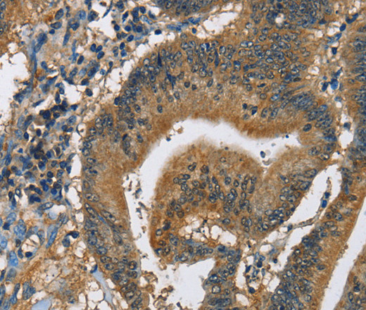 Immunohistochemistry of paraffin-embedded Human colon cancer using CAST Polyclonal Antibody at dilution of 1:60