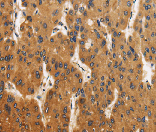 Immunohistochemistry of paraffin-embedded Human liver cancer using CALU Polyclonal Antibody at dilution of 1:40