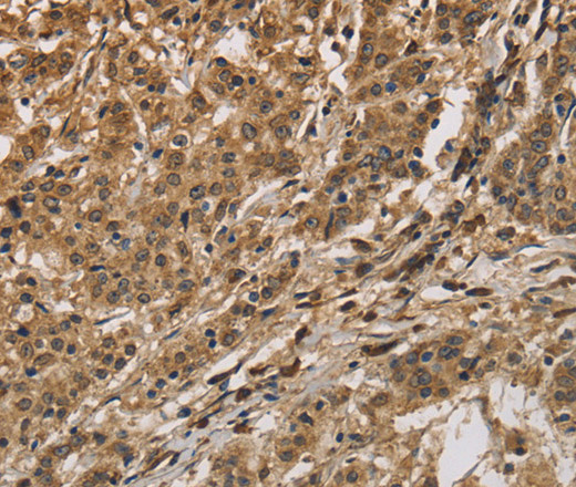 Immunohistochemistry of paraffin-embedded Human gastric cancer using CALU Polyclonal Antibody at dilution of 1:40