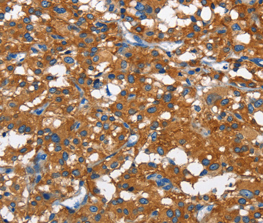 Immunohistochemistry of paraffin-embedded Human thyroid cancer tissue using CAMK1D Polyclonal Antibody at dilution 1:50