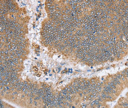 Immunohistochemistry of paraffin-embedded Human colon cancer using CANX Polyclonal Antibody at dilution of 1:50