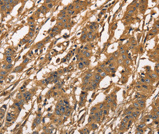 Immunohistochemistry of paraffin-embedded Human gasrtic cancer tissue using CAPZA3 Polyclonal Antibody at dilution 1:40