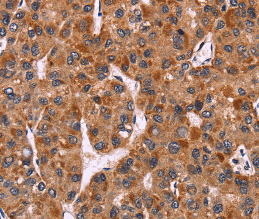 Immunohistochemistry of paraffin-embedded Human liver cancer tissue using CARD11 Polyclonal Antibody at dilution 1:40