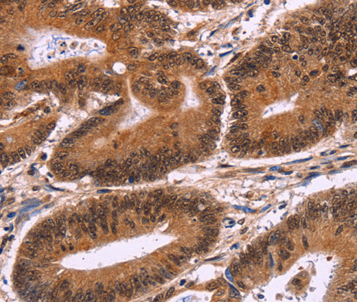 Immunohistochemistry of paraffin-embedded Human colon cancer tissue using CARD11 Polyclonal Antibody at dilution 1:40