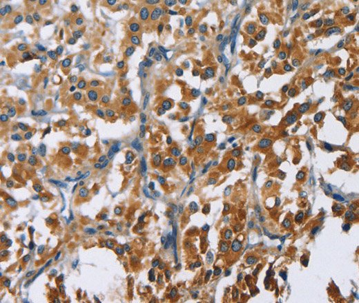 Immunohistochemistry of paraffin-embedded Human thyroid cancer tissue using CARD9 Polyclonal Antibody at dilution 1:60