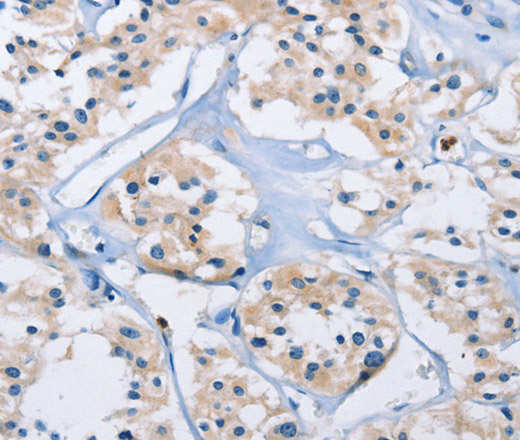 Immunohistochemistry of paraffin-embedded Human thyroid cancer using CARD14 Polyclonal Antibody at dilution of 1:30