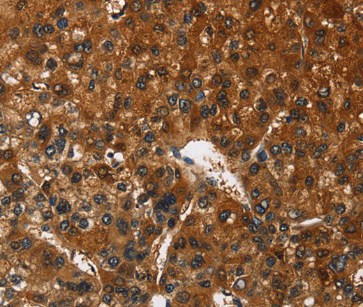 Immunohistochemistry of paraffin-embedded Human liver cancer tissue using CATSPER4 Polyclonal Antibody at dilution 1:50