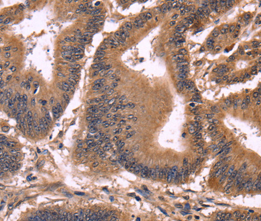 Immunohistochemistry of paraffin-embedded Human colon cancer tissue using CCDC106 Polyclonal Antibody at dilution 1:50