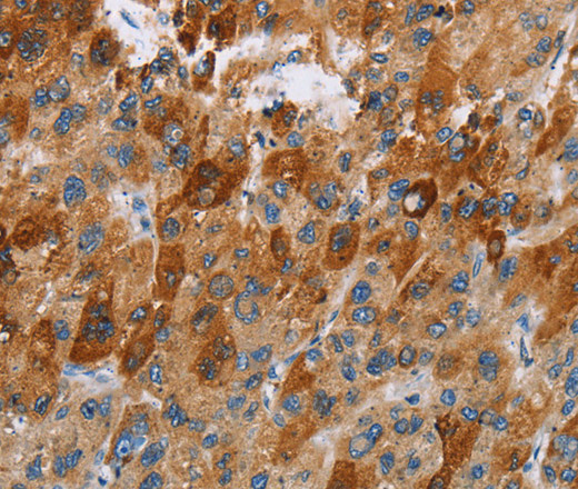 Immunohistochemistry of paraffin-embedded Human liver cancer tissue using CCR9 Polyclonal Antibody at dilution 1:40