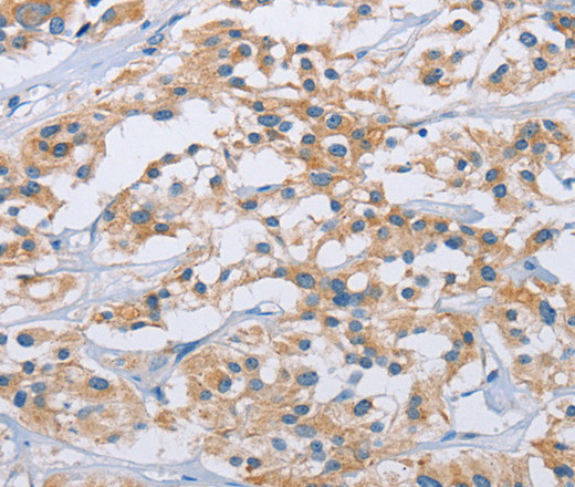 Immunohistochemistry of paraffin-embedded Human thyroid cancer tissue using CCR9 Polyclonal Antibody at dilution 1:40