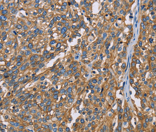 Immunohistochemistry of paraffin-embedded Human esophagus cancer using BSG Polyclonal Antibody at dilution of 1:60