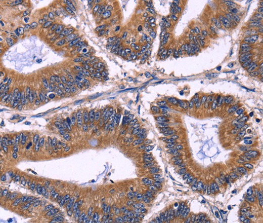 Immunohistochemistry of paraffin-embedded Human colon cancer tissue using KIR2DL1/3/4/S4 Polyclonal Antibody at dilution 1:40