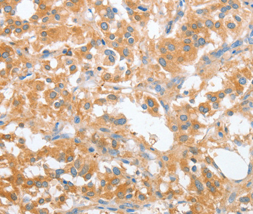 Immunohistochemistry of paraffin-embedded Human thyroid cancer tissue using OX2R Polyclonal Antibody at dilution 1:60