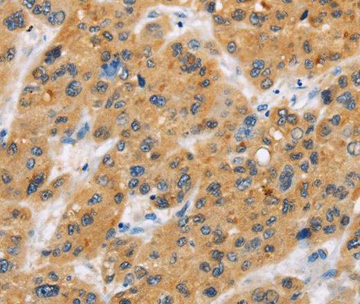 Immunohistochemistry of paraffin-embedded Human liver cancer tissue using CD272 Polyclonal Antibody at dilution 1:30