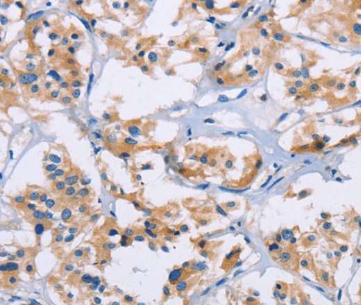 Immunohistochemistry of paraffin-embedded Human thyroid cancer tissue using NCR3 Polyclonal Antibody at dilution 1:40