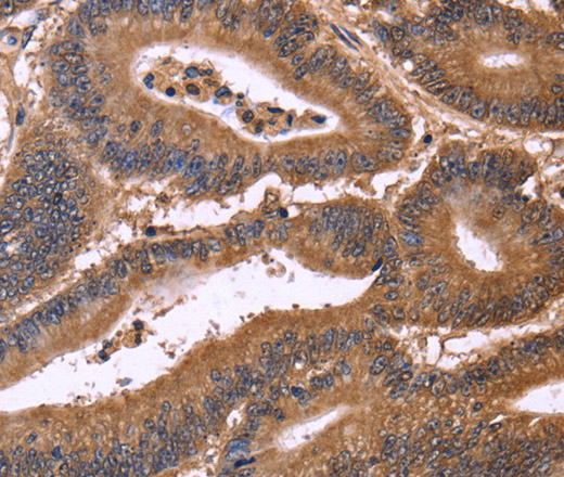 Immunohistochemistry of paraffin-embedded Human colon cancer tissue using CDC37L1 Polyclonal Antibody at dilution 1:50