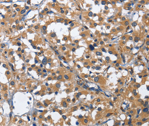 Immunohistochemistry of paraffin-embedded Human thyroid cancer using HSF27 Polyclonal Antibody at dilution of 1:40