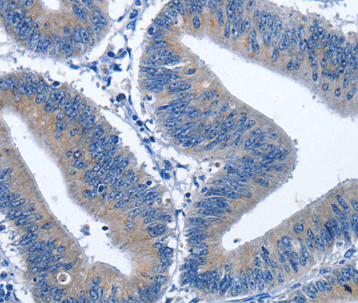 Immunohistochemistry of paraffin-embedded Human colon cancer using HSF27 Polyclonal Antibody at dilution of 1:40