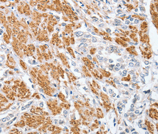 Immunohistochemistry of paraffin-embedded Human prostate cancer tissue using CENPC Polyclonal Antibody at dilution 1:70