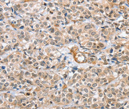 Immunohistochemistry of paraffin-embedded Human esophagus cancer tissue using CENPC Polyclonal Antibody at dilution 1:70