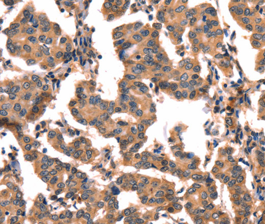 Immunohistochemistry of paraffin-embedded Human breast cancer tissue using hCG Polyclonal Antibody at dilution 1:65