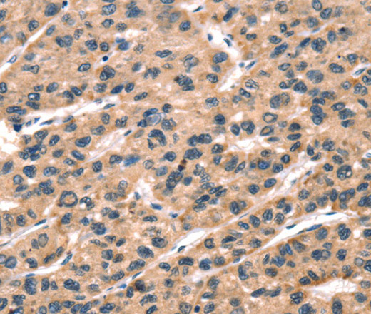 Immunohistochemistry of paraffin-embedded Human liver cancer tissue using hCG Polyclonal Antibody at dilution 1:65