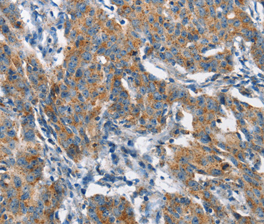 Immunohistochemistry of paraffin-embedded Human gastic cancer using CHMP1A Polyclonal Antibody at dilution of 1:60